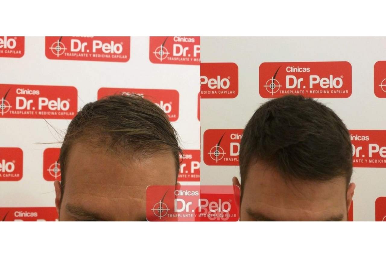Señales de alopecia por el Dr. Pelo
