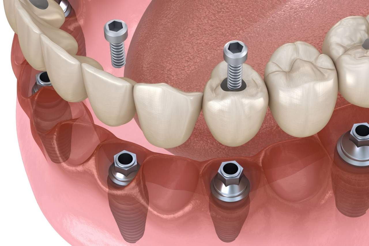 ¿Los implantes duran para siempre?¿Qué cuidados necesitan? Profesionales de Helident Training Center