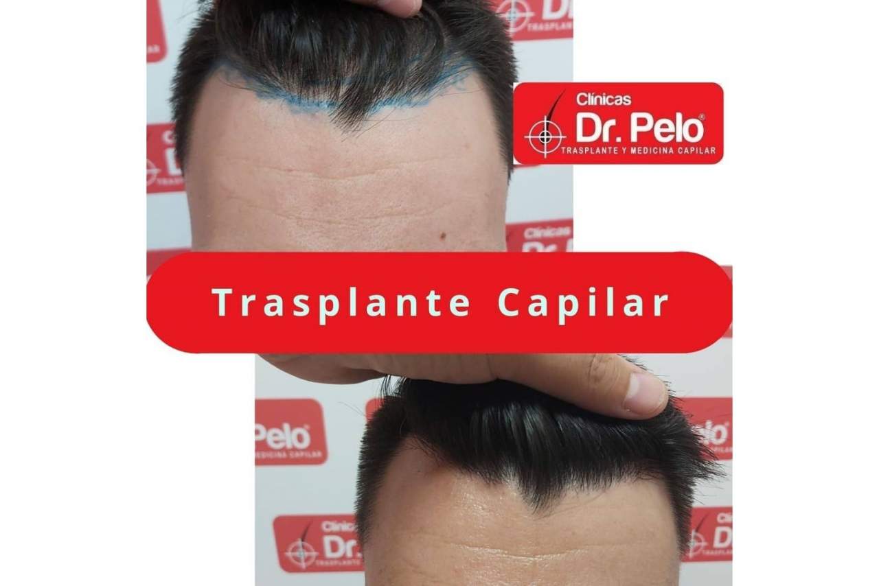 Comentarios sobre el injerto capilar de las Clínicas Dr. Pelo en Sevilla