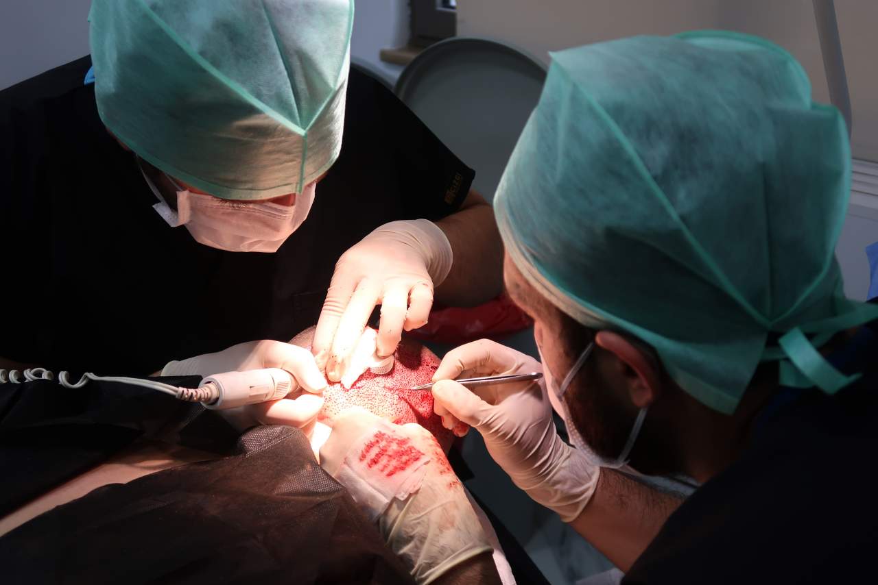 Un 42% de hombres en España son calvos, ¿cómo retrasar ese efecto? Método DHI por Dr. Bern Barbehito