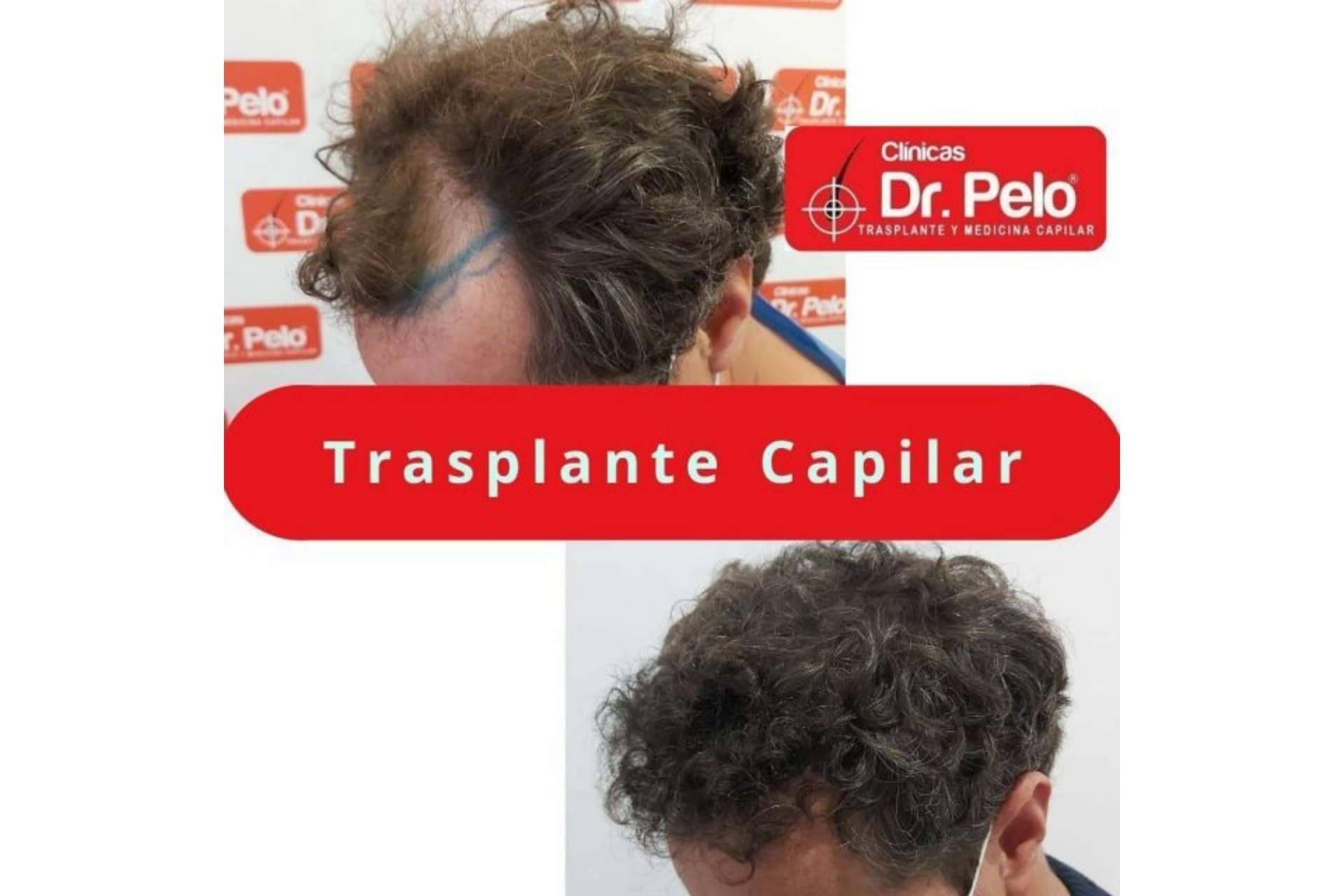 La profesionalidad de las Clínicas Dr. Pelo hace que el injerto capilar en Sevilla gane popularidad