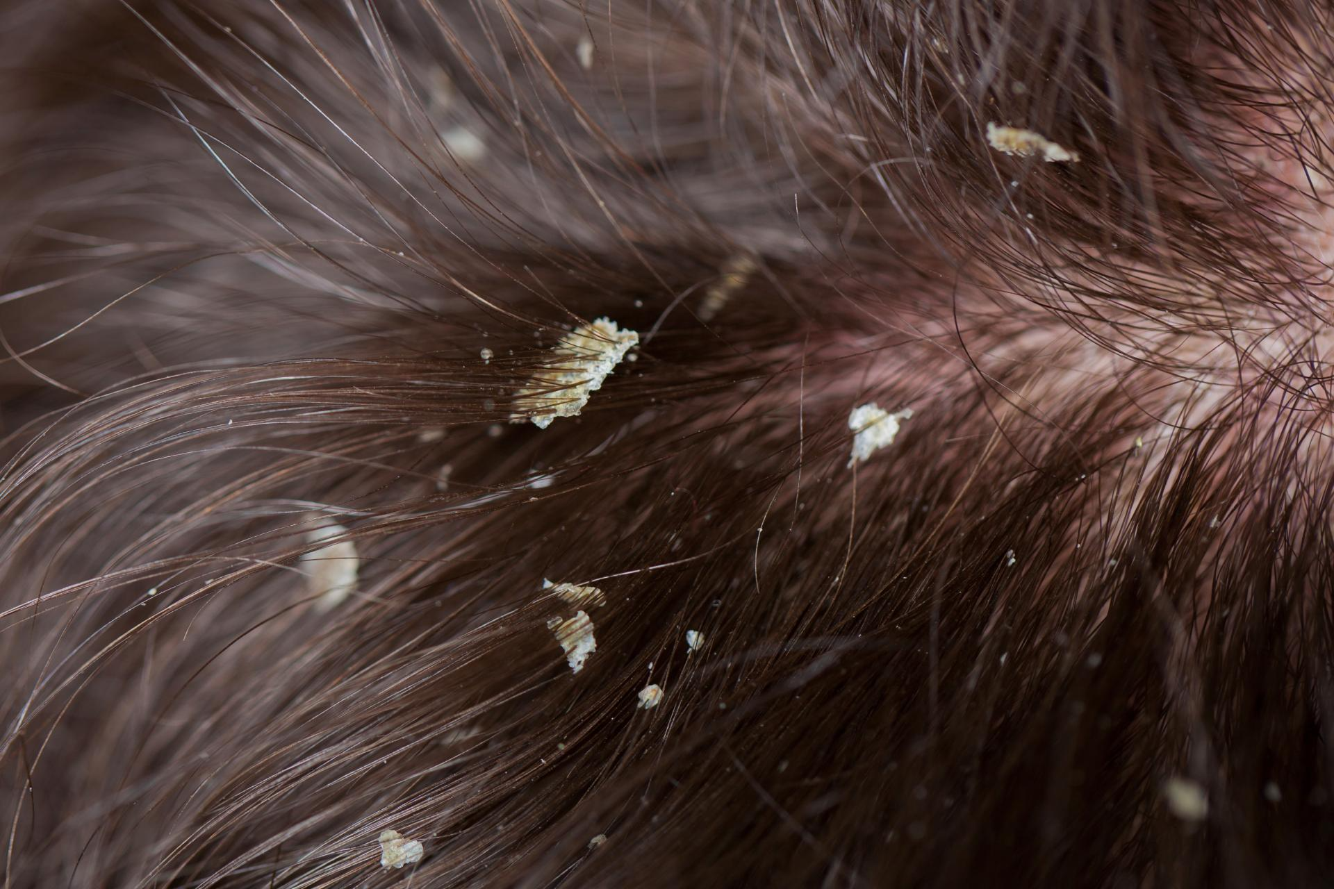 Costras en el cuero cabelludo, el tratamiento creado por el Laboratorio Géomer Pure Nature