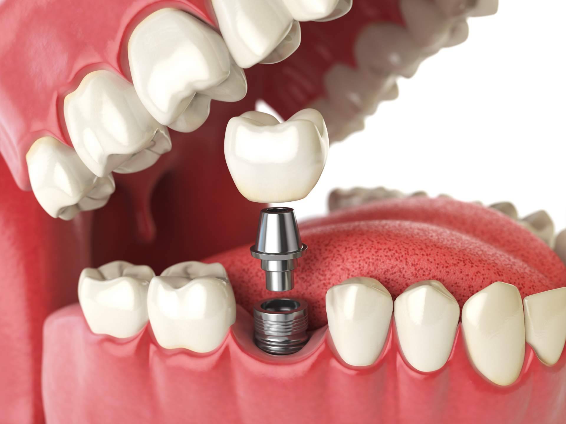 Clínica de Odontología Artydents de Madrid anuncia su implante dental de titanio por solo 199€