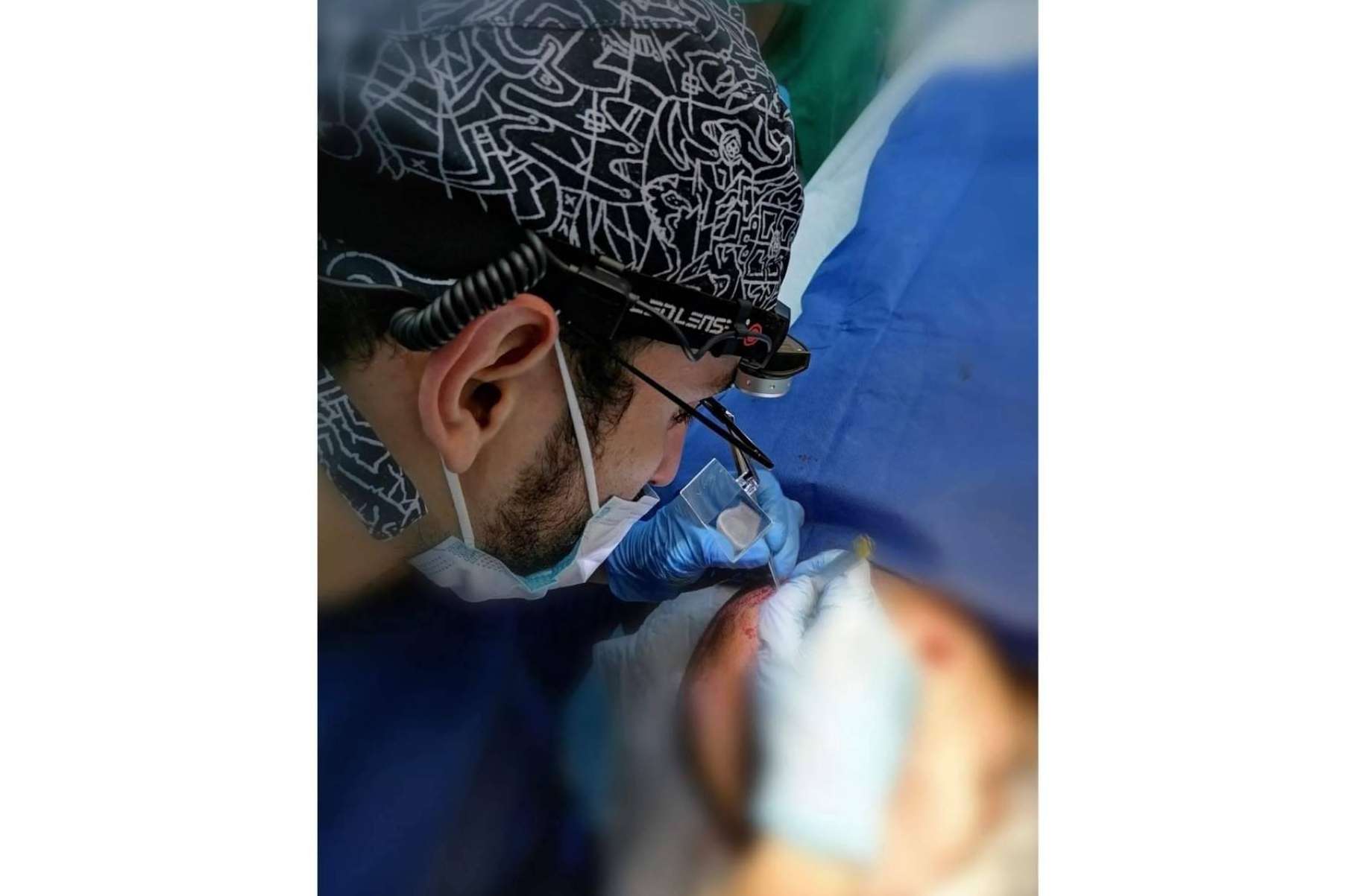 La técnica DHI empleada por el Dr. Bern permite conseguir resultados naturales en el trasplante capilar