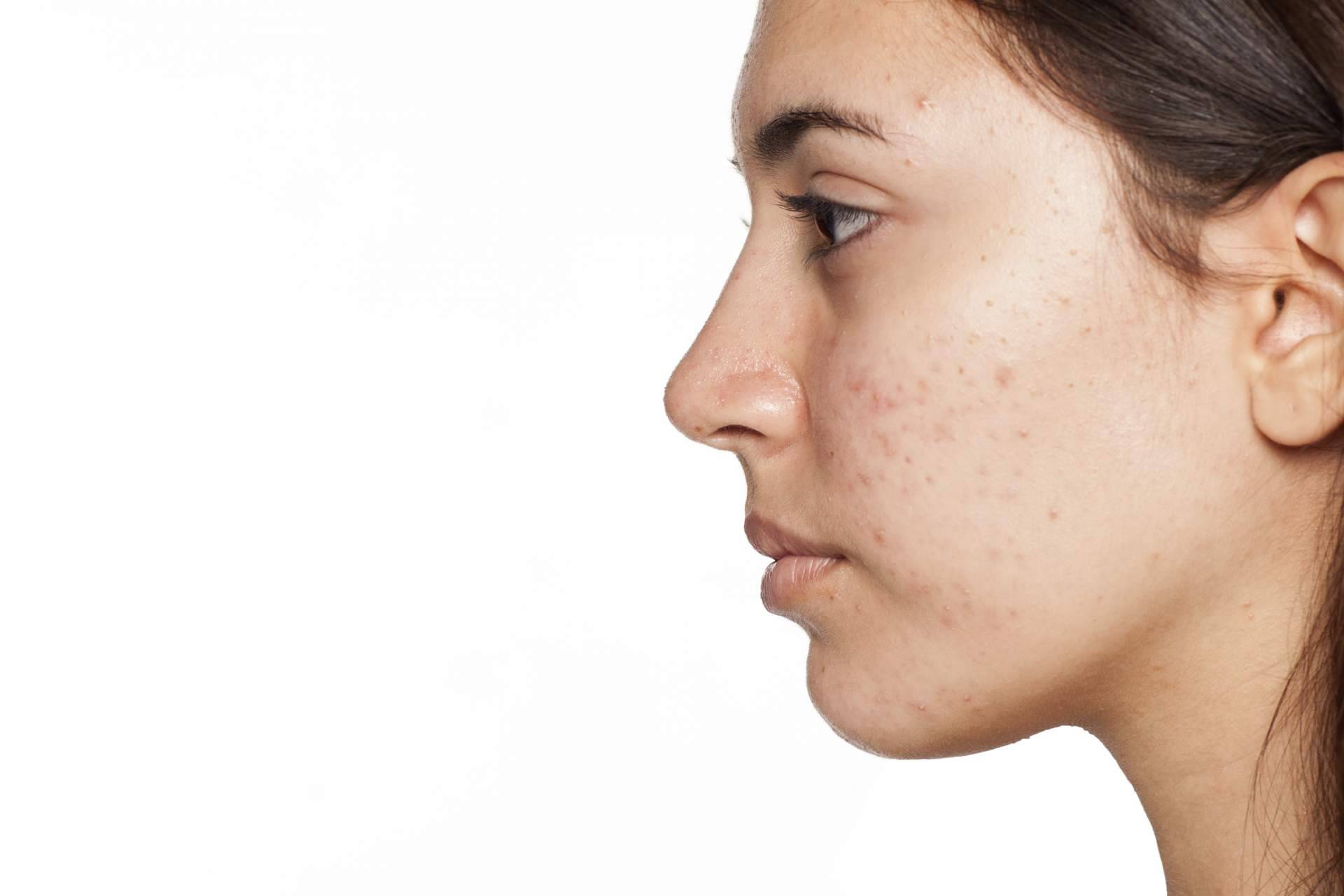 Terminar con las espinillas y el acné es posible actualmente gracias a AcnéXero, una aplicación de inteligencia artificial fundada por dos dermatólogos