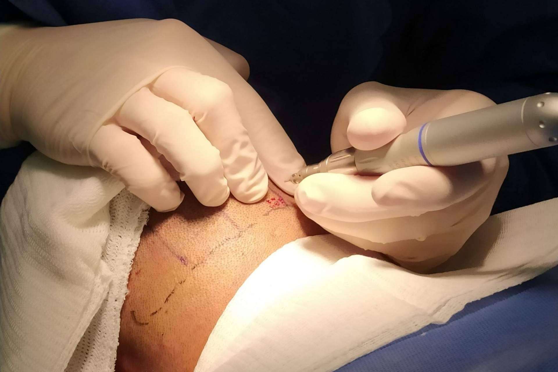 La técnica del microinjerto capilar realizada en la clínica estética de Alcobendas de Clínica Tarrazo