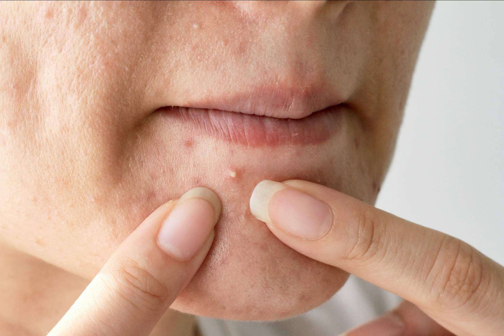 ¿Cómo tratar el acné juvenil con una selfie? por AcnéXero