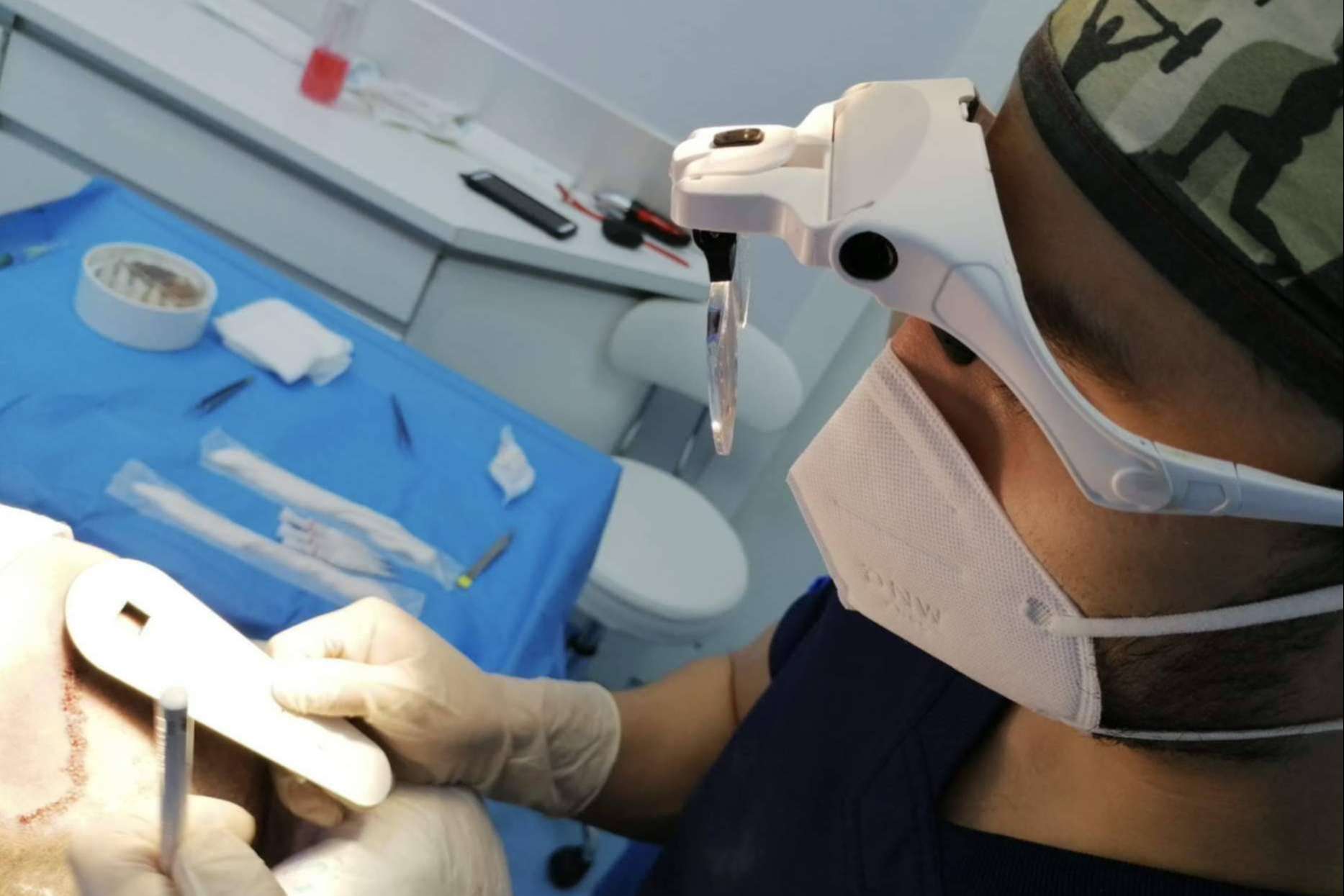 La fase del desierto capilar: ¿En qué momento se cae el pelo implantado?, por Doctor Bern