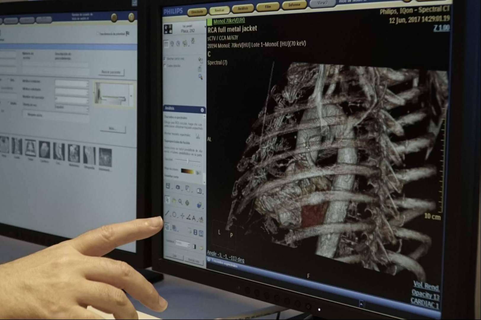 La importancia de prevenir y detectar patologías o anomalías cardiovasculares con el escáner de imagen espectral de Bach Care