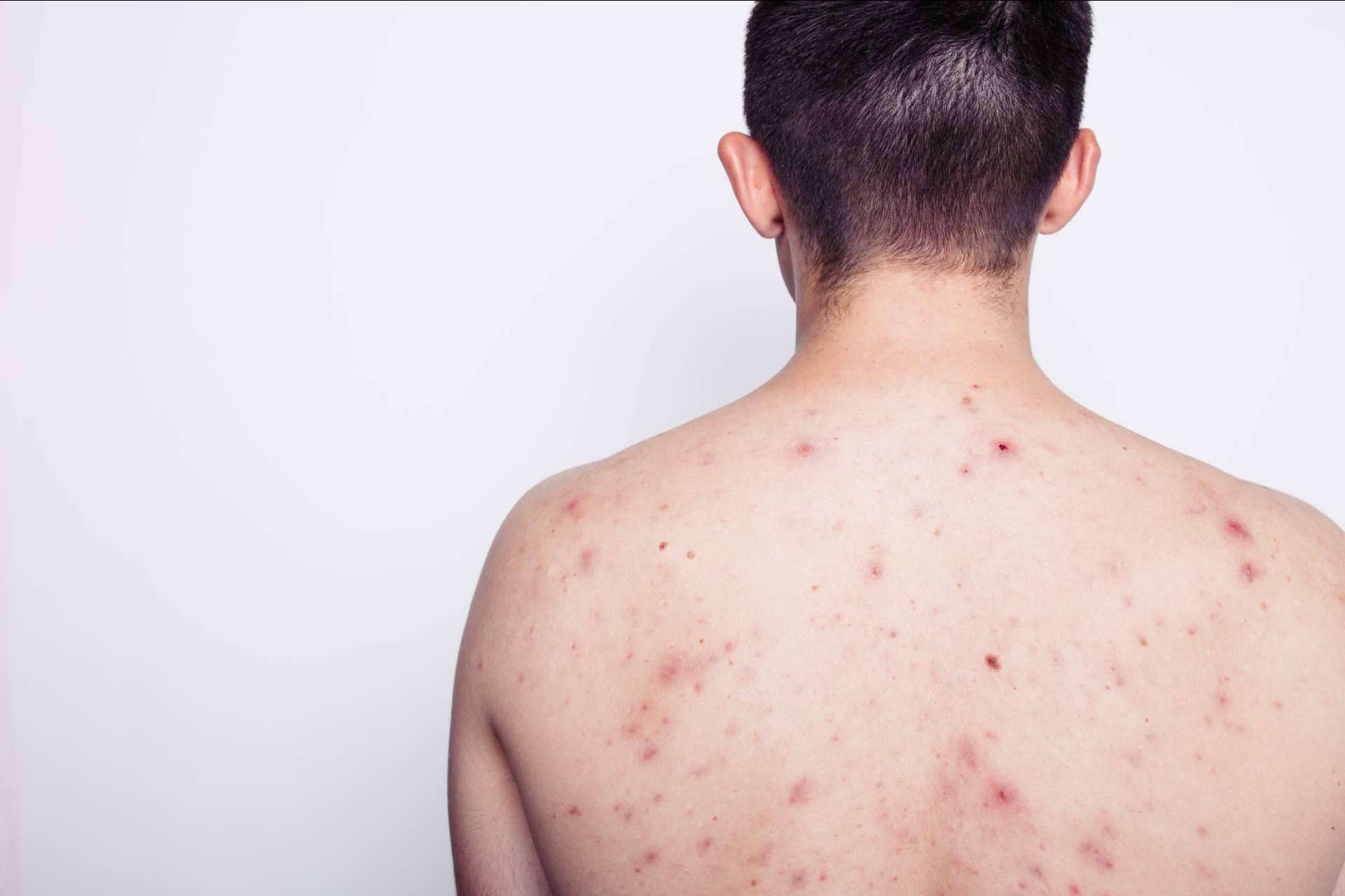 AcnéXero, la aplicación ideada por dermatólogos que propone soluciones efectivas contra el acné