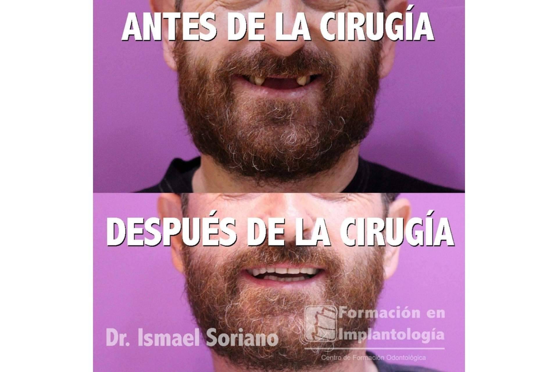 La técnica del Dr. Ismael Soriano que ofrece múltiples ventajas a los pacientes, los implantes con dientes inmediatos