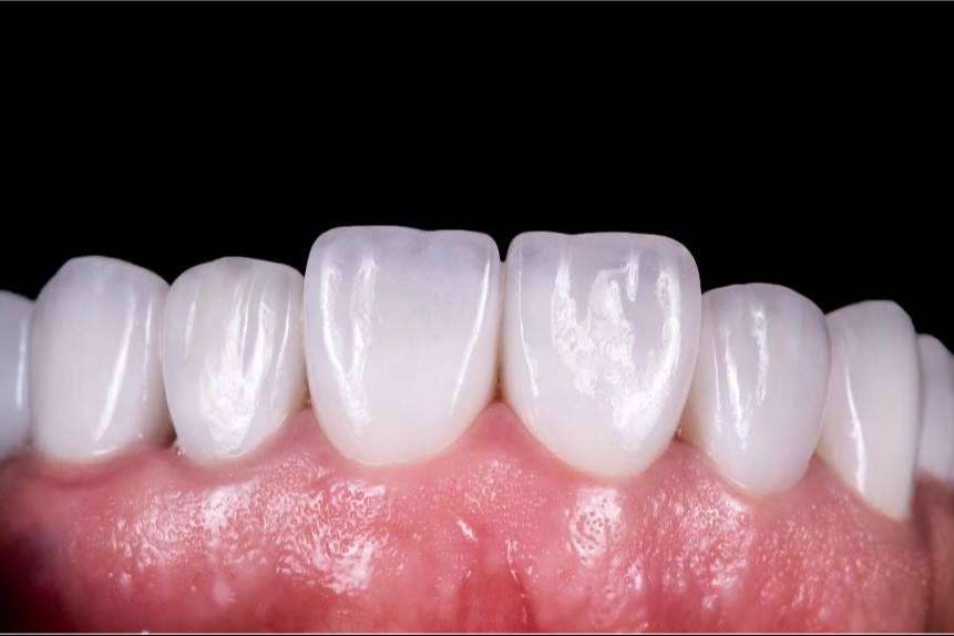 Clínicas Qualident y sus implantes dentales innovadores en Hospitalet