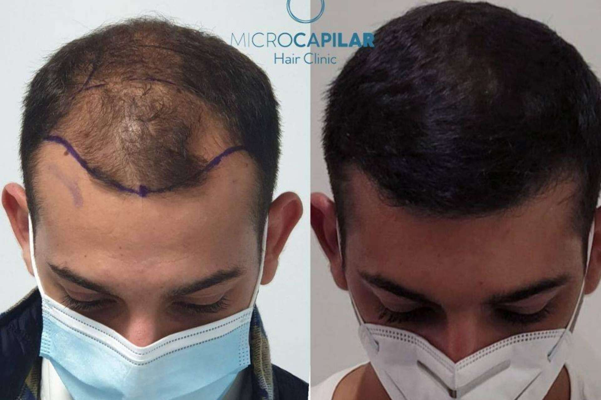 ¿Dónde realizarse un injerto capilar con máxima extracción folicular? Microcapilar Hair Clinic