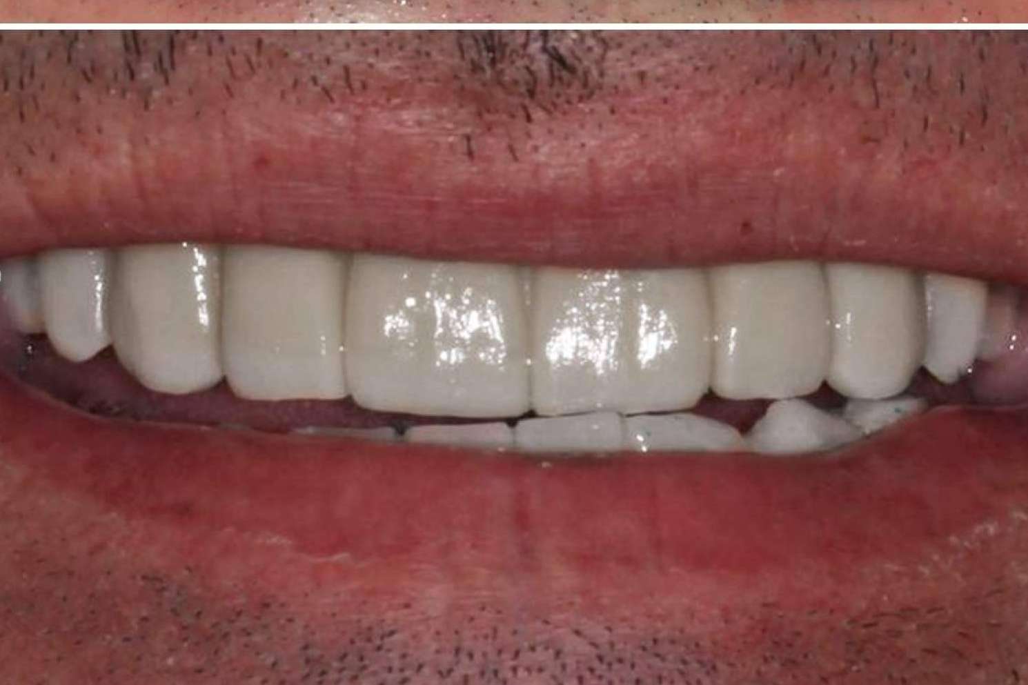 Los beneficios del tratamiento ALL ON 4 de Implant Clinics