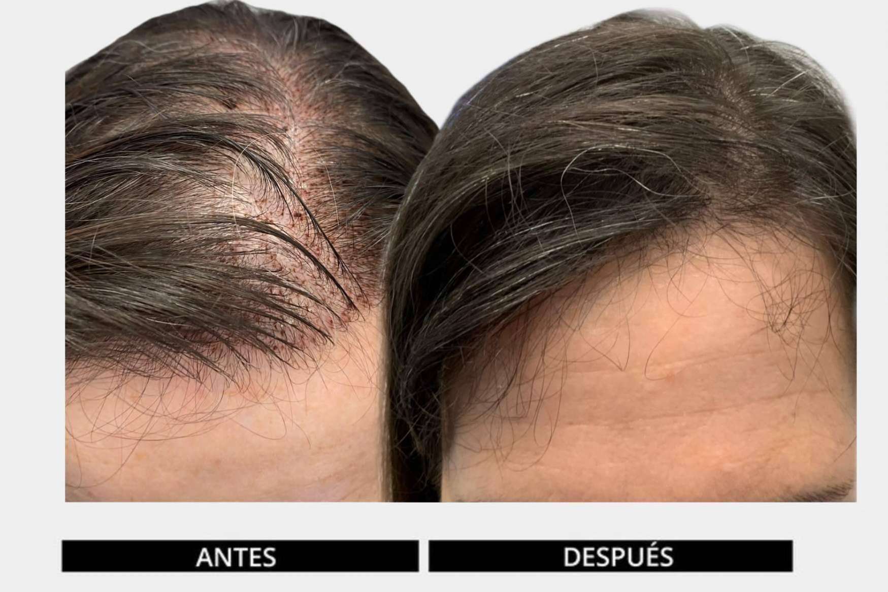 Dedicación, clave del éxito de los tratamientos con el método DHI para retrasar el efecto de la calvicie