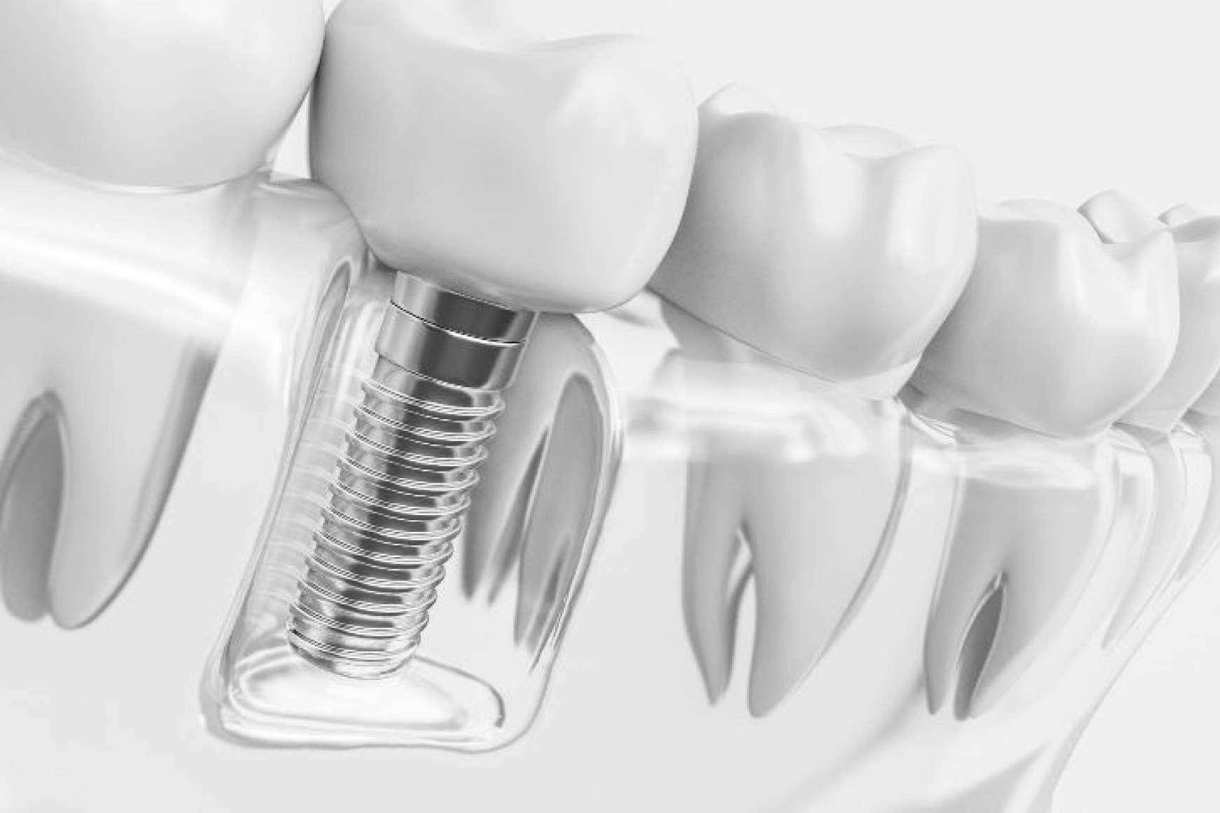 Grupo Gente Vital asegura la calidad de sus tratamientos de ortodoncia invisible