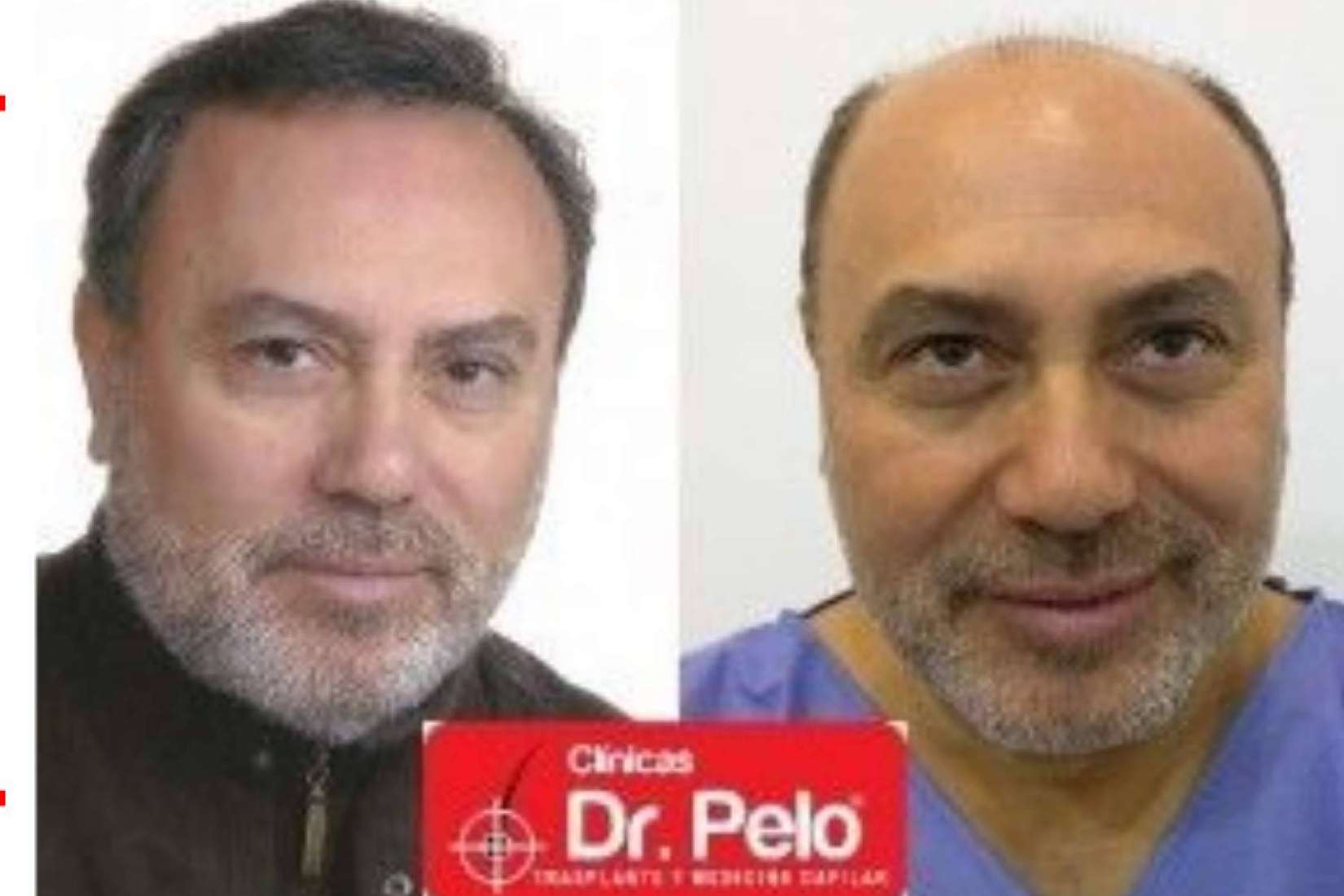 La importancia de conseguir trasplantes capilares efecto natural, por Clínicas Dr. Pelo