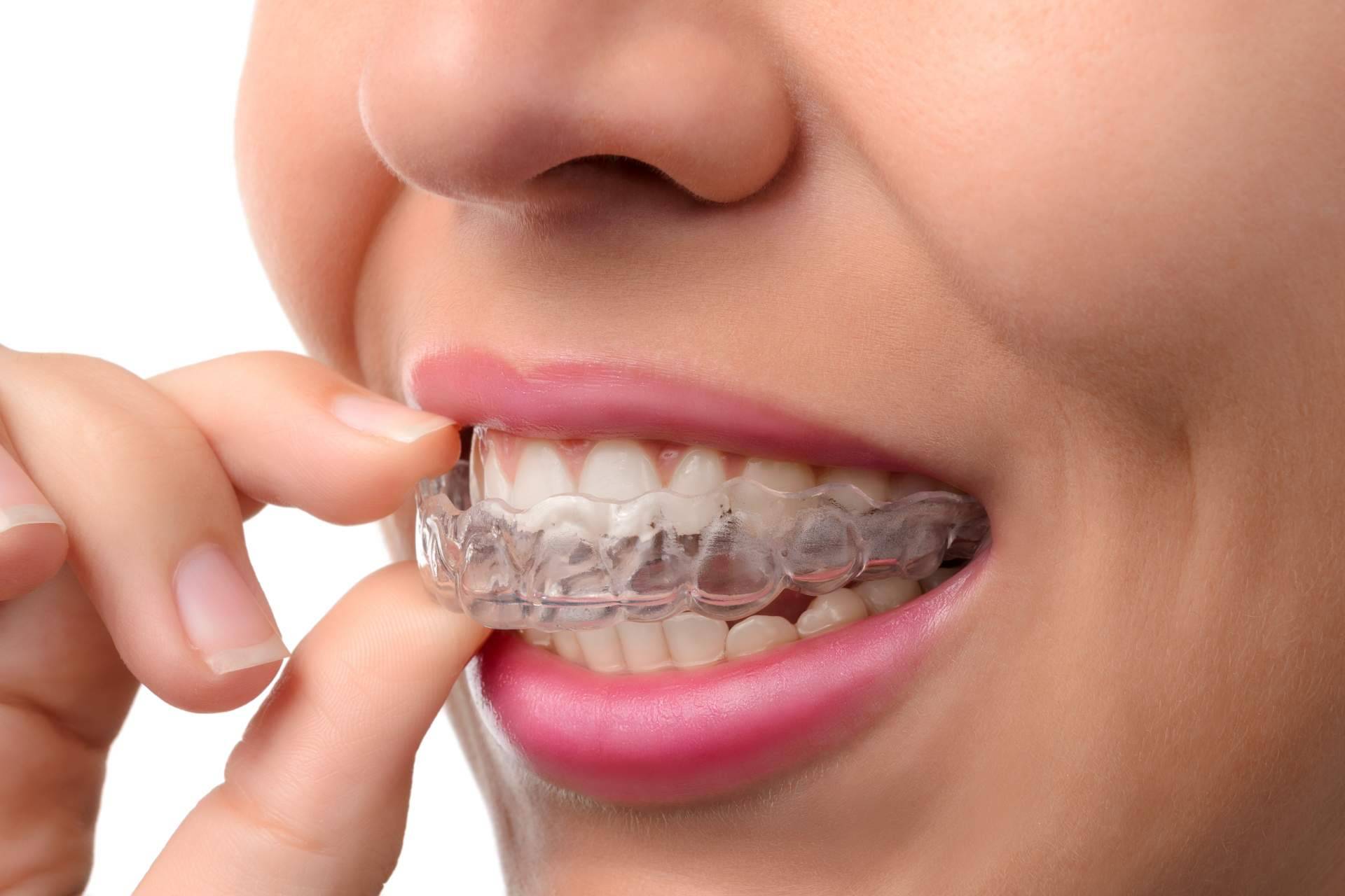 DeltaDent ofrece tratamientos con Invisalign