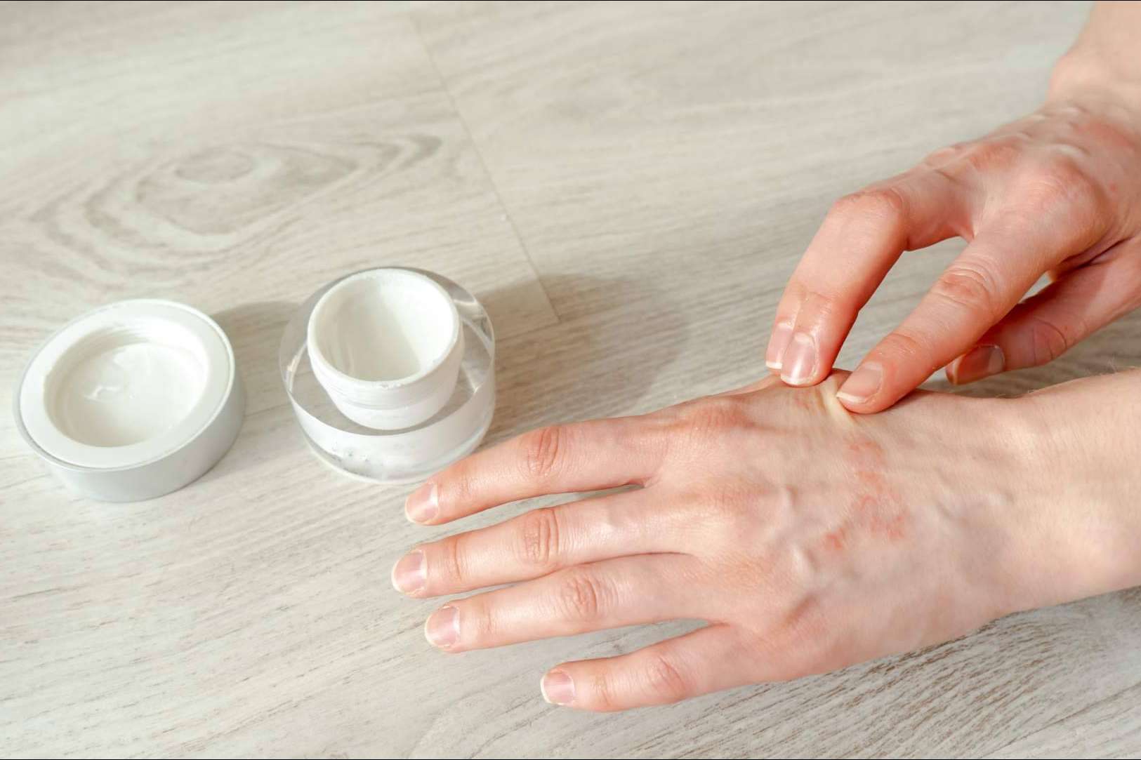 ¿Eczema atópico o eczema de contacto?, por Laboratorio Géomer