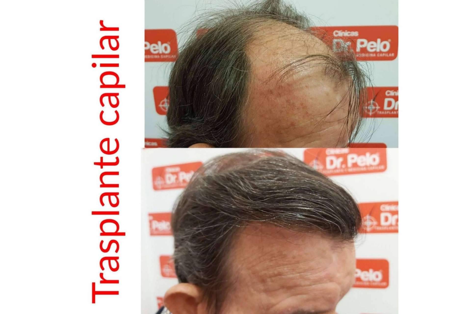 Realizar la Técnica Progresiva Capilar de la mano de Dr. Afonso Junior con una primera cita online gratuita