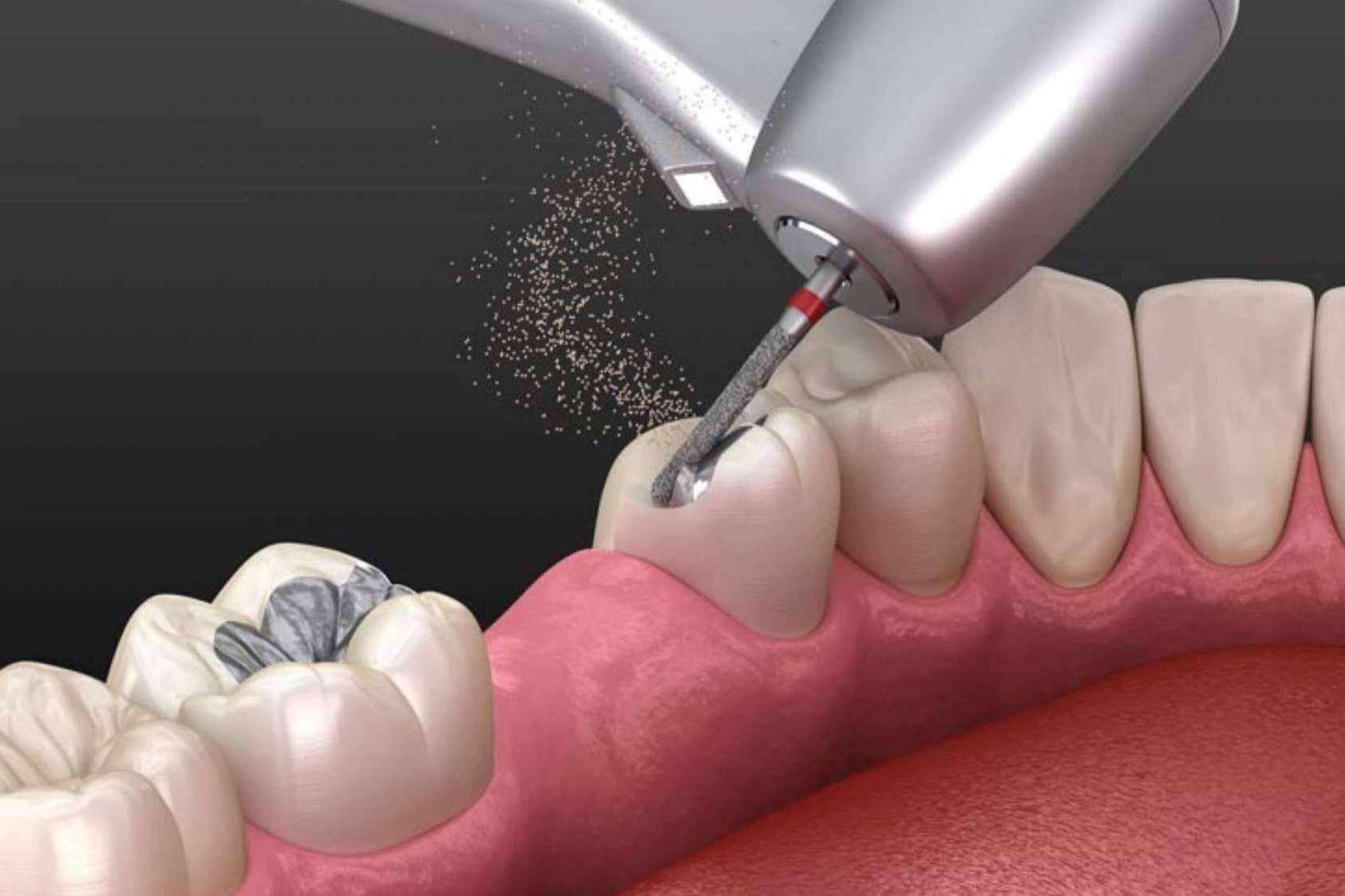 La calidad de las fresas dentales contribuye a que el instrumento dure más tiempo, según Precisión Médica Dental