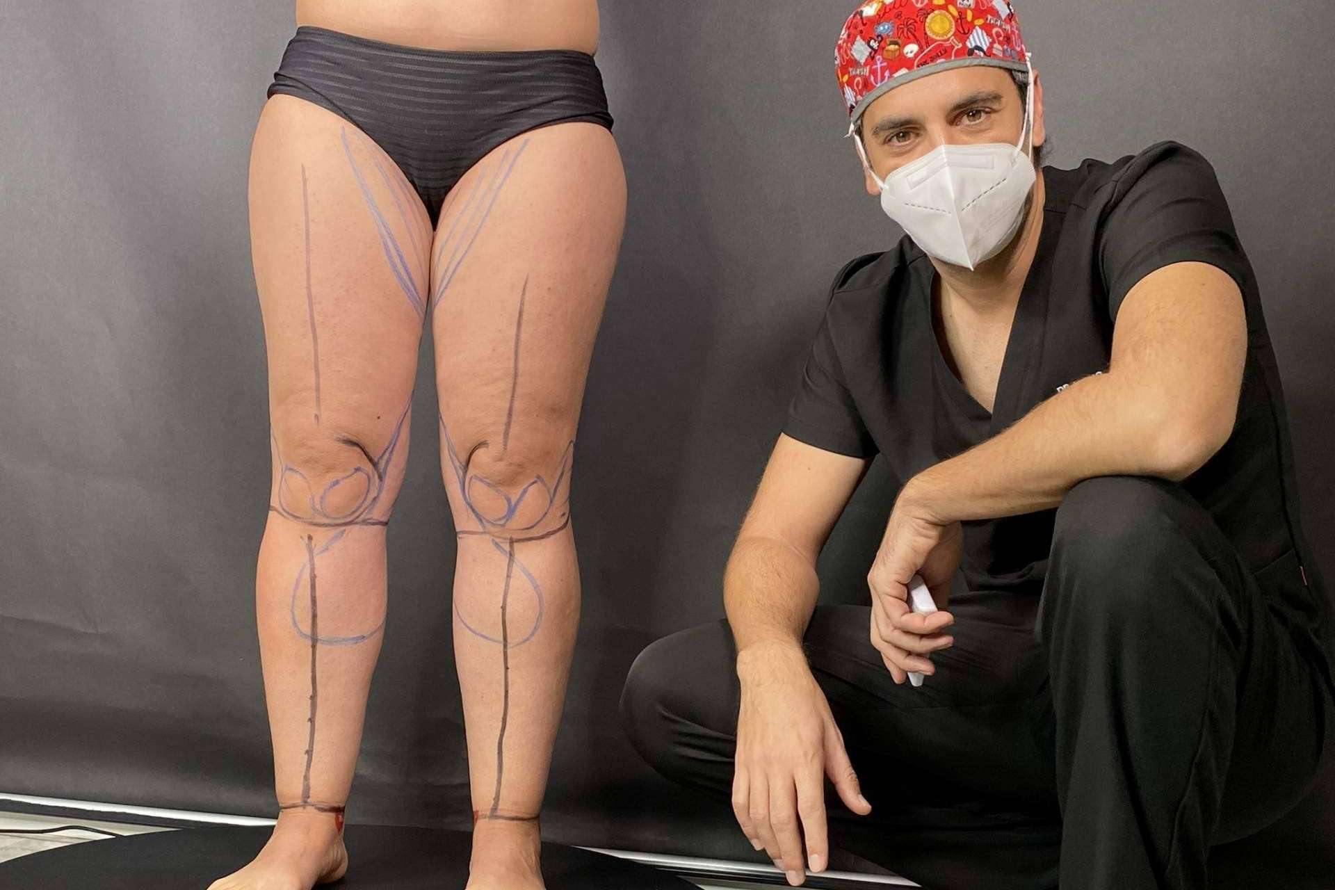 Nace el Instituto Valenciano de Lipedema, IVALI