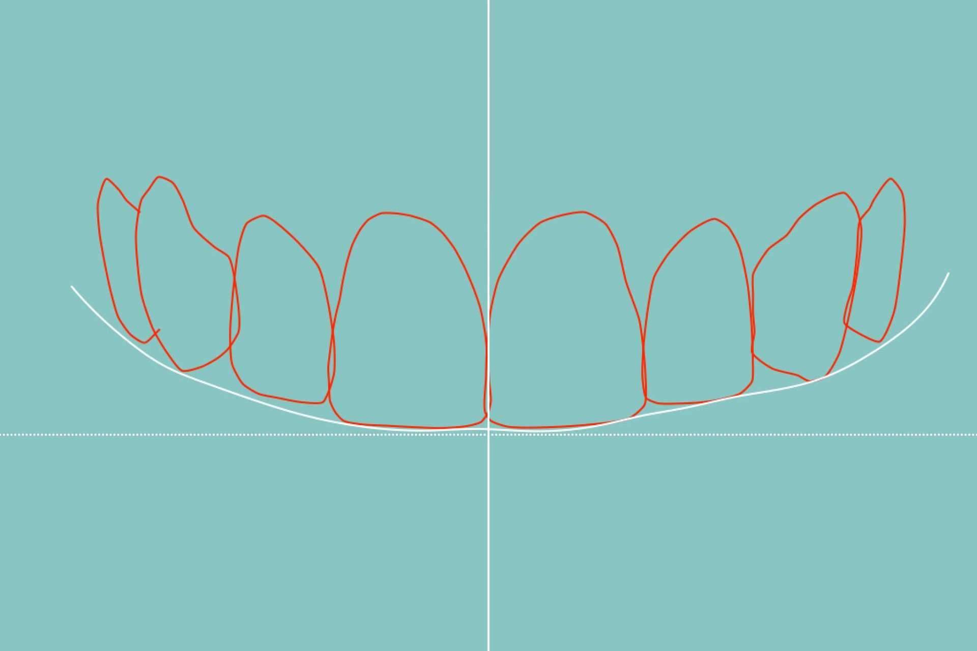 Tecnología de vanguardia para el diseño de sonrisa en Clínica Dental Blay + Monzó