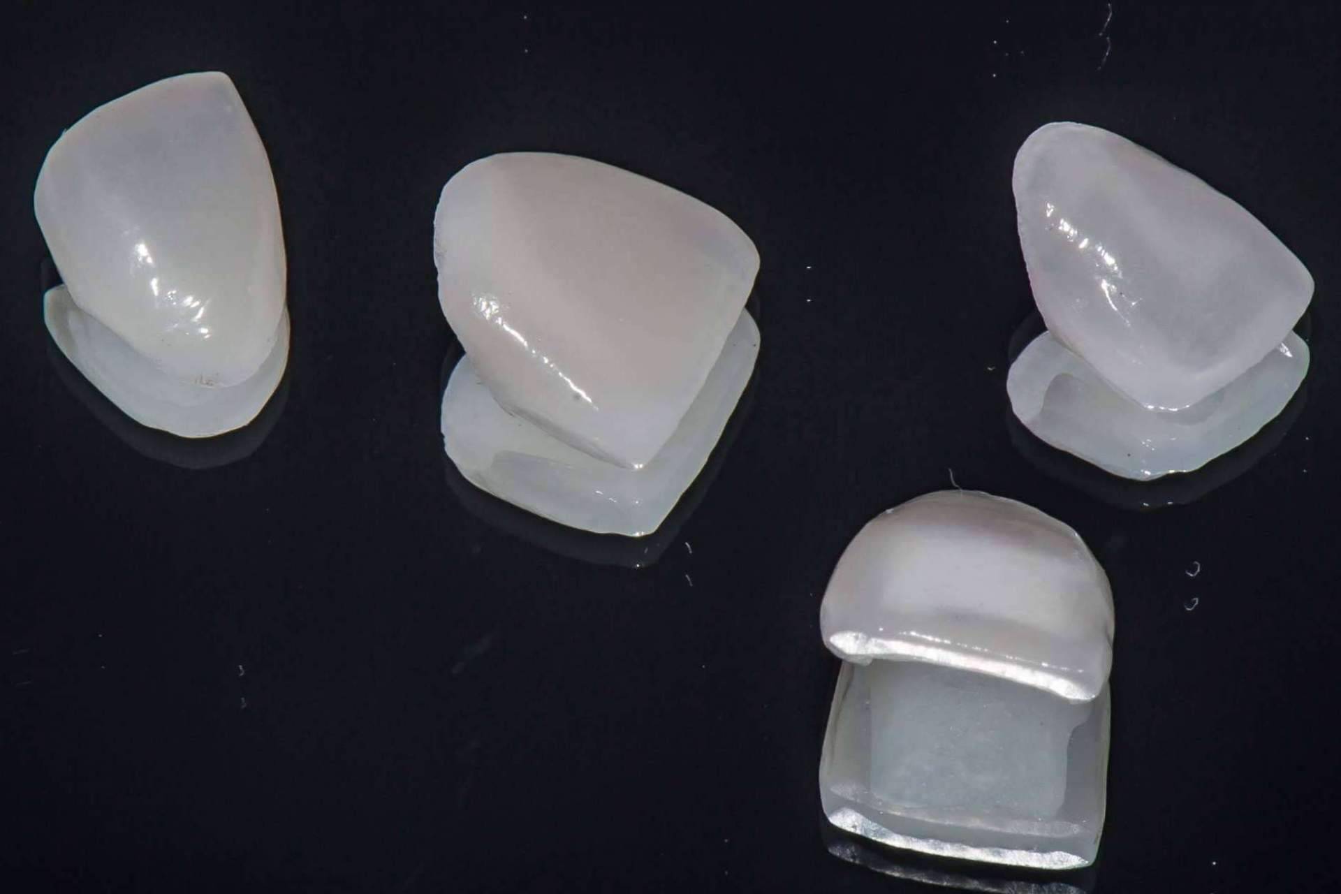 Carillas dentales de porcelana, uno de los mejores tratamientos para mejorar la estética dental