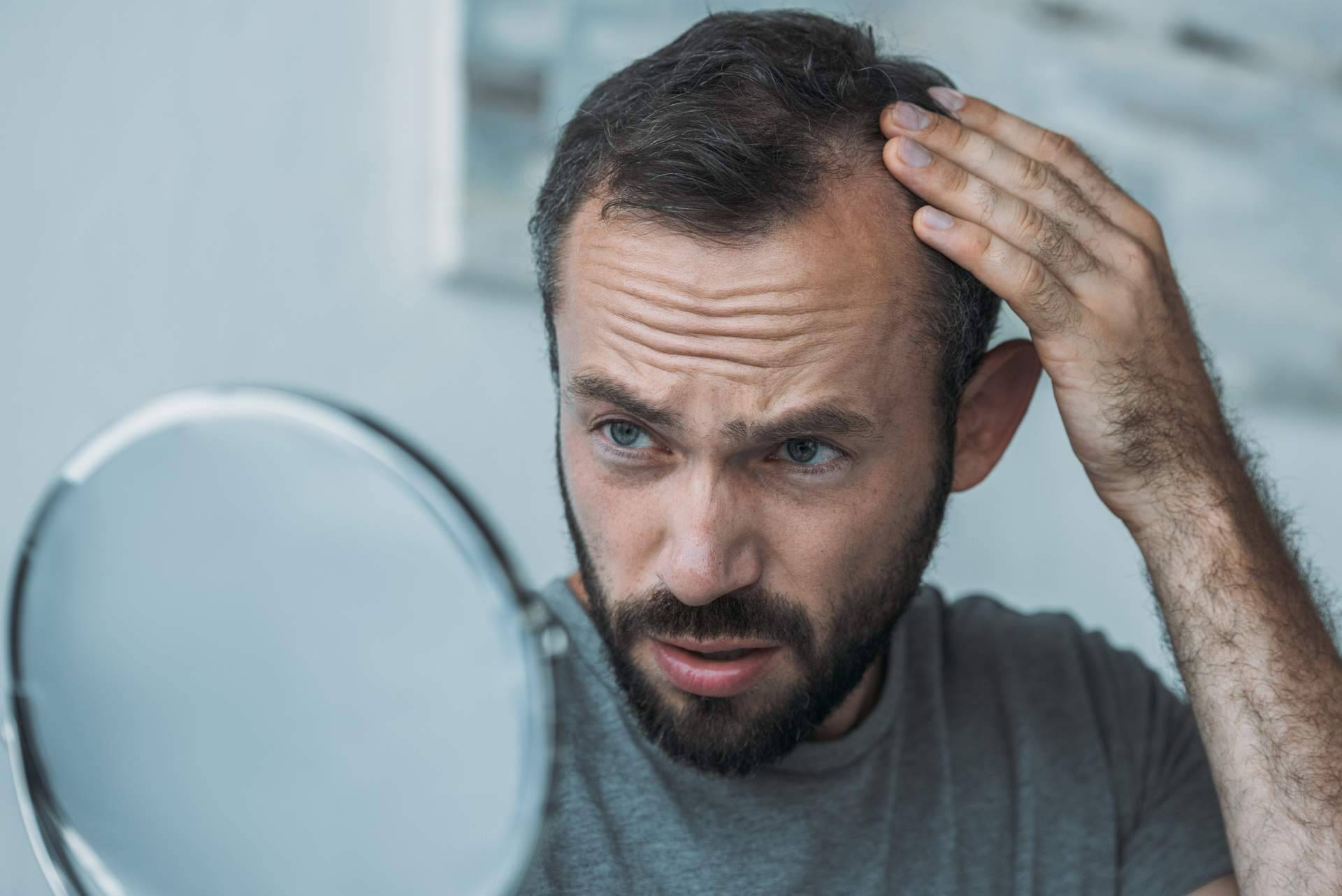 Combatir la alopecia androgénica gracias a Saw Palmetto