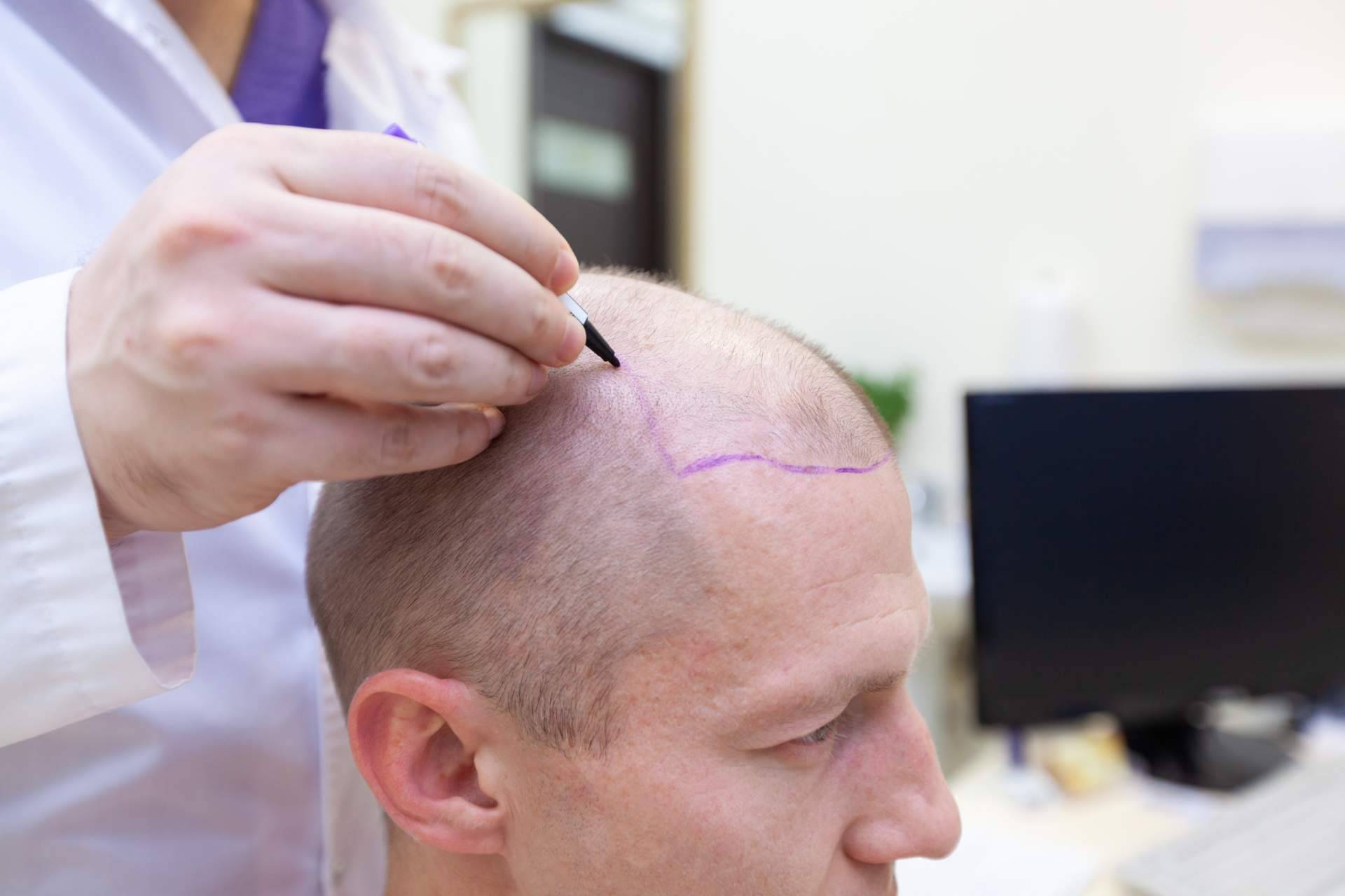 Élite Capilar combate la alopecia con injertos capilares efectivos