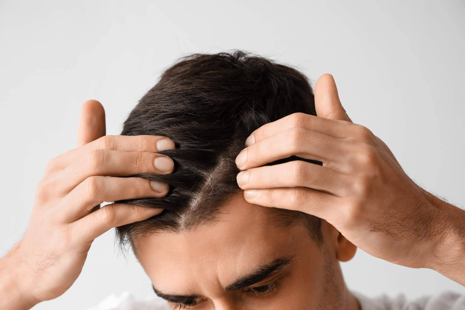 La Clínica Estética SILOE es especialista en realizar el tratamiento de injerto capilar Valladolid