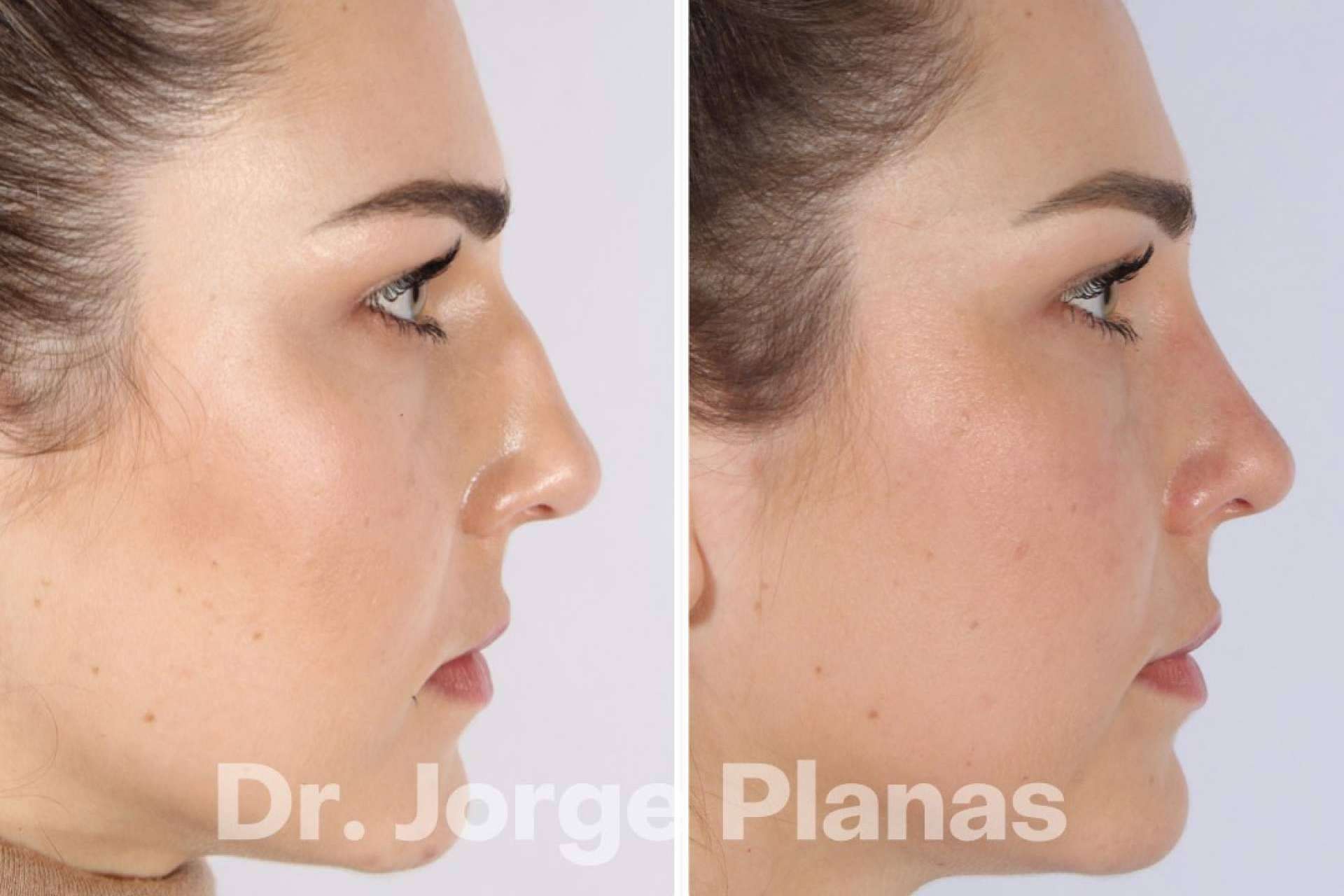 El Dr. Jorge Planas ofrece un tratamiento de rinoplastia ultrasónica