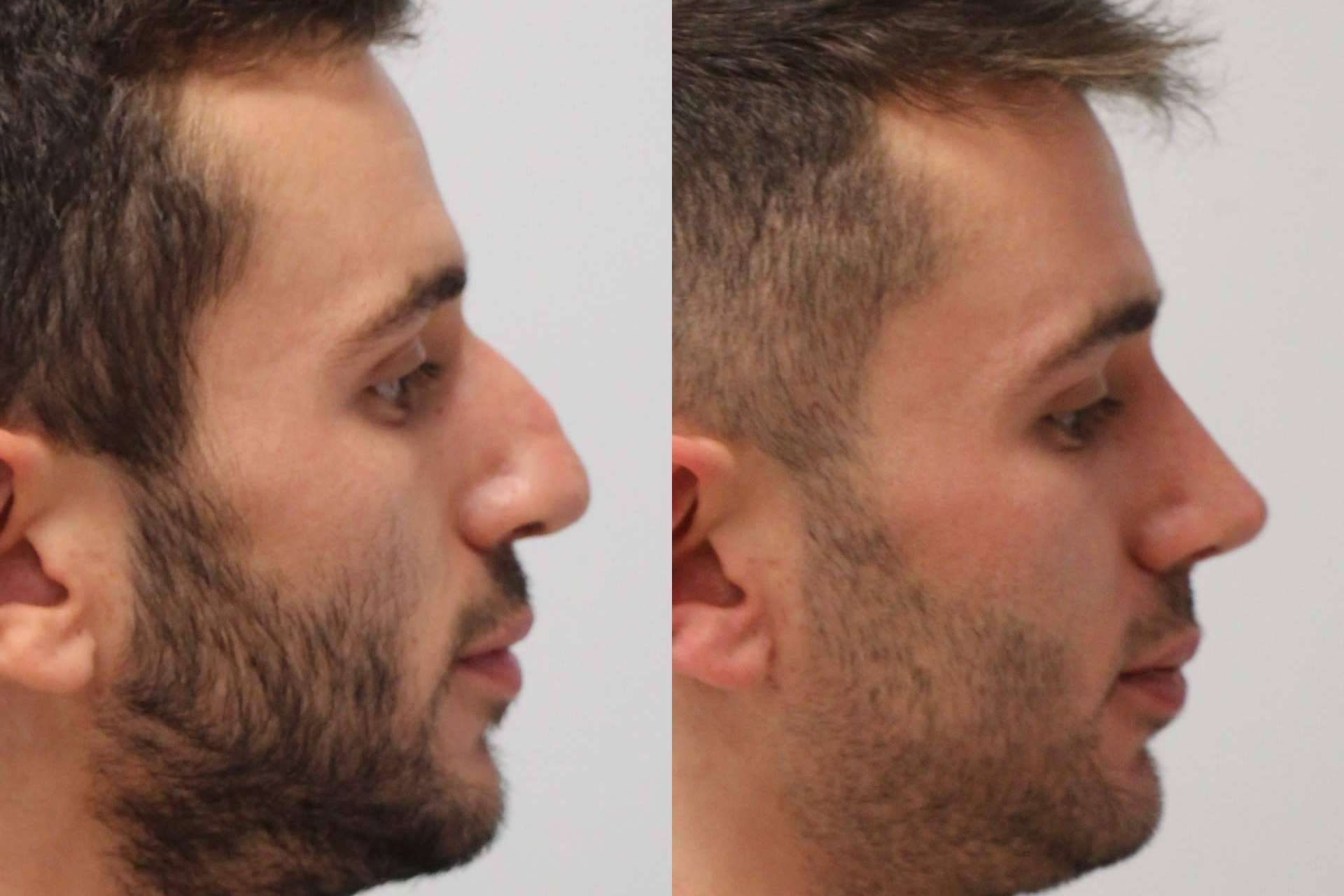 En Valladolid y Santander está disponible el avance médico de la rinoplastia ultrasónica