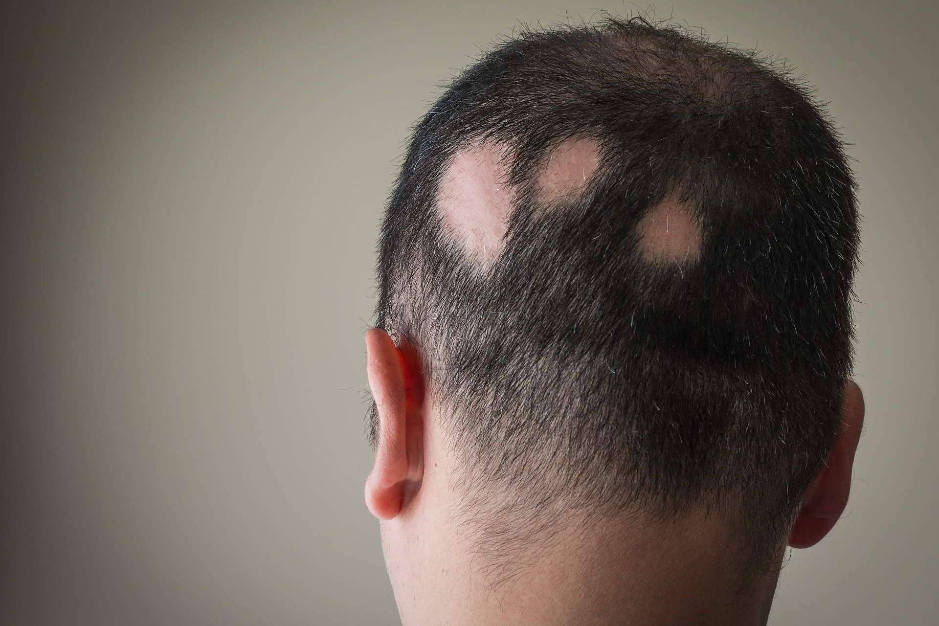 Saw Palmetto comercializa un tratamiento para alopecia areata