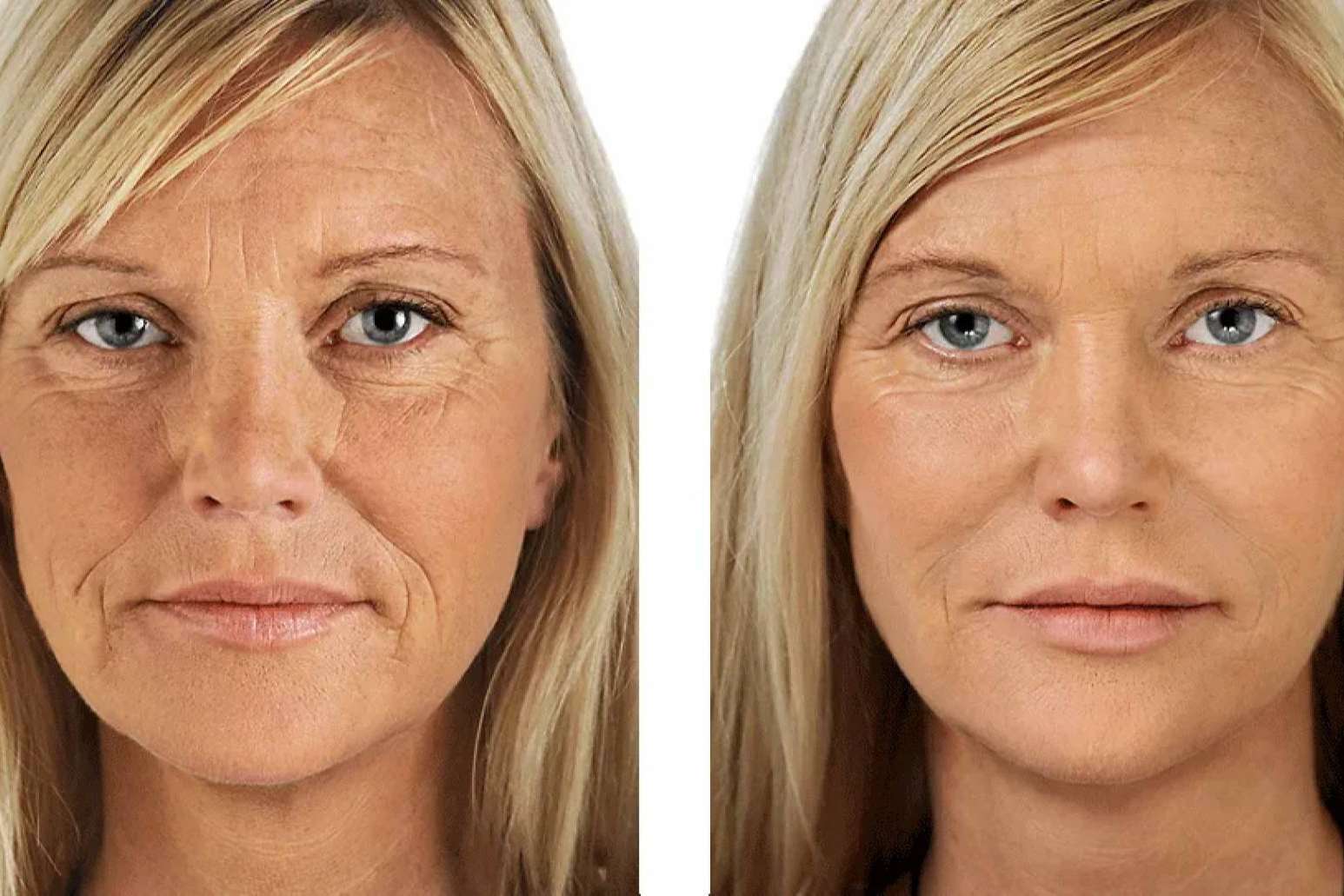 Combatir los signos del envejecimiento con el PRP facial de KōAN Club