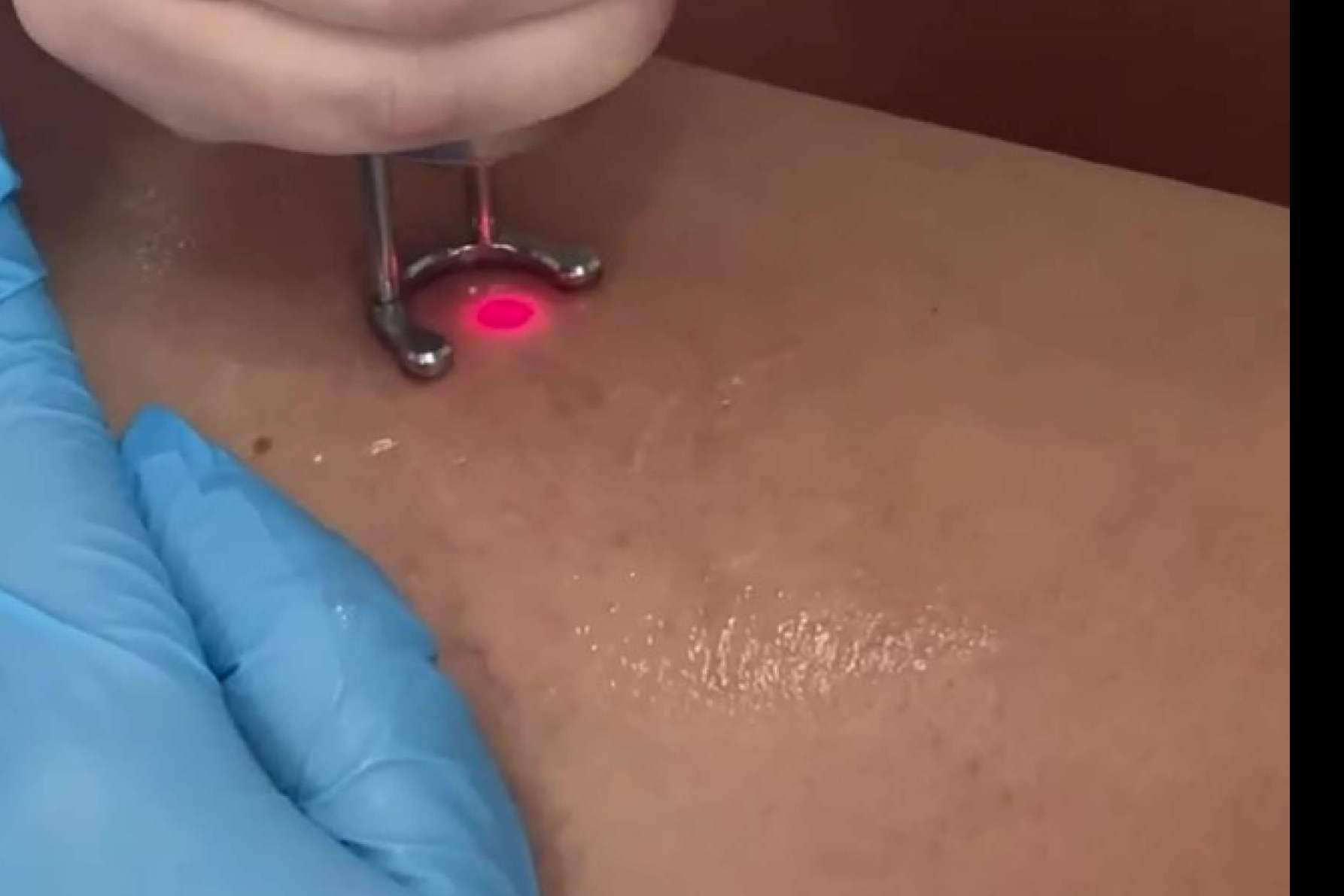 Eliminar las varices con la doctora Yasmin Al Adib en su clínica situada en Sevilla