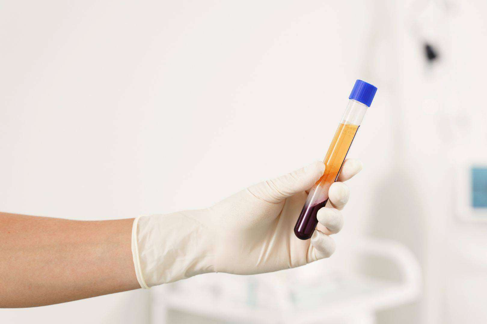 La potente terapia regenerativa de doble efecto basada en plasma rico en plaquetas y dutasterida contra la caída del cabello